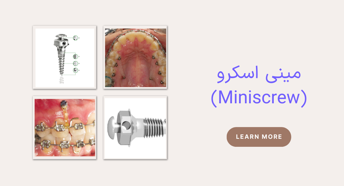 مینی اسکرو (Miniscrew)