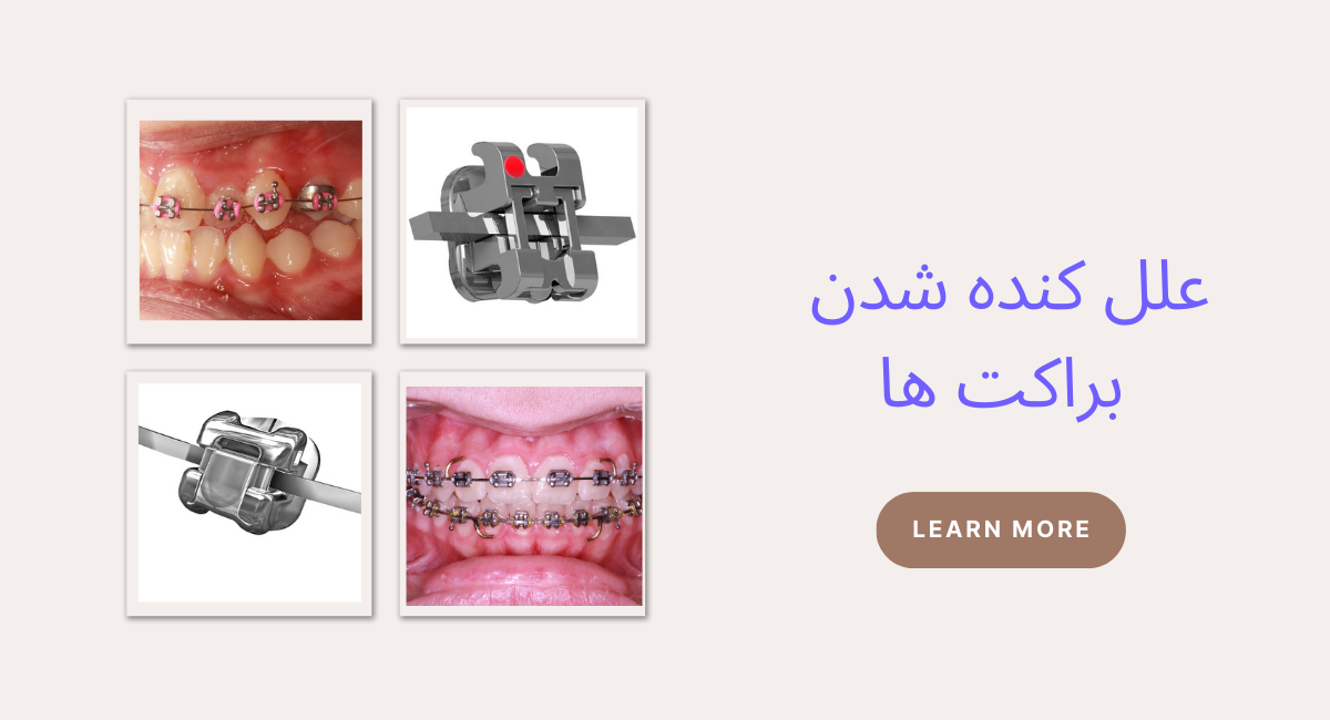 علل کنده شدن براکت‌ها