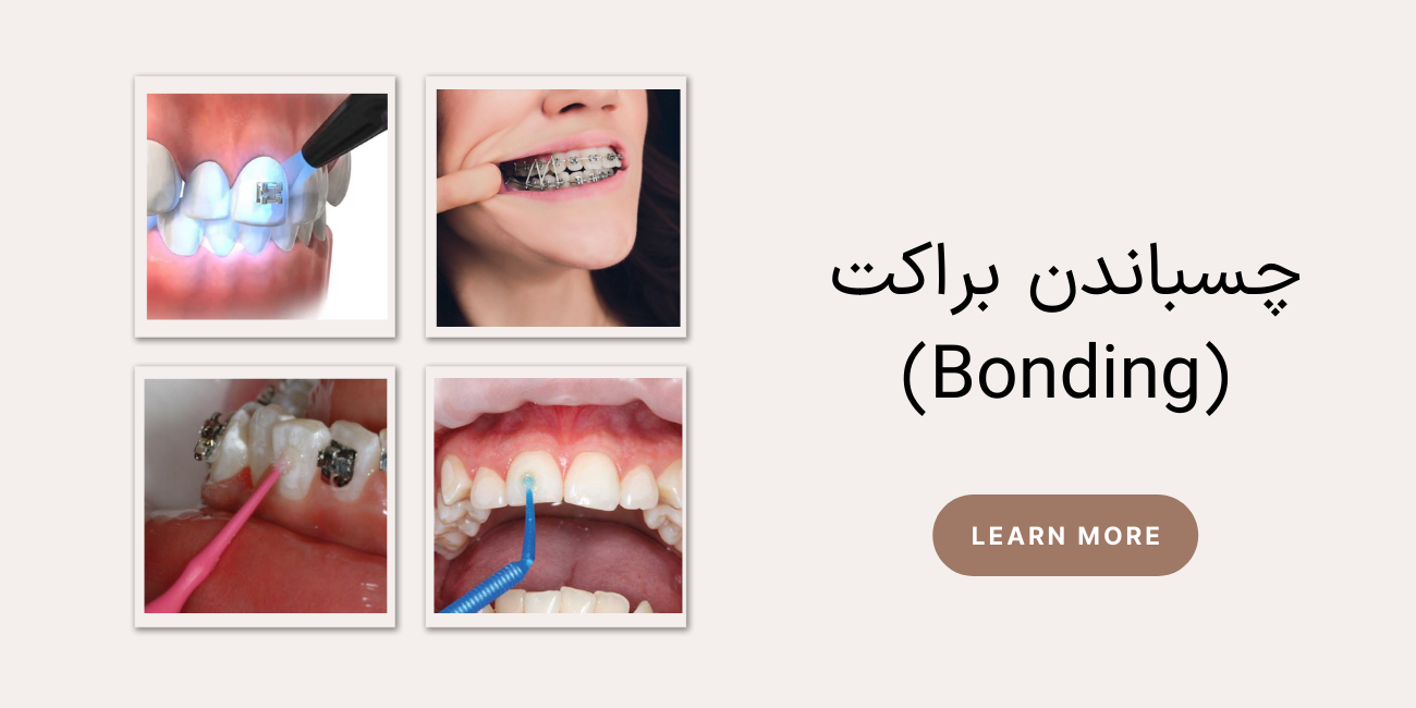 چسباندن براکت (Bonding)
