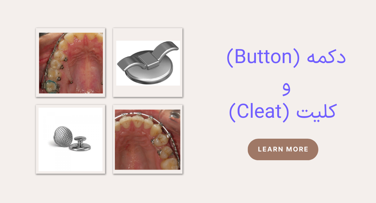 دکمه (Button) و کلیت (Cleat)