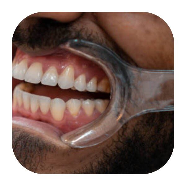 دهان باز کن مخصوص فتوگرافی چینی قابل اتوکلاو